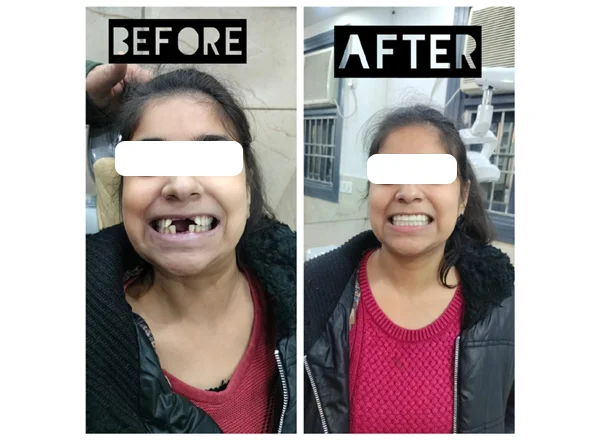 Before and After