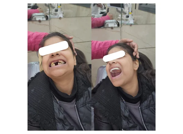 Before and After