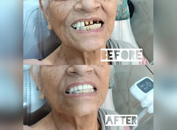 Before and After