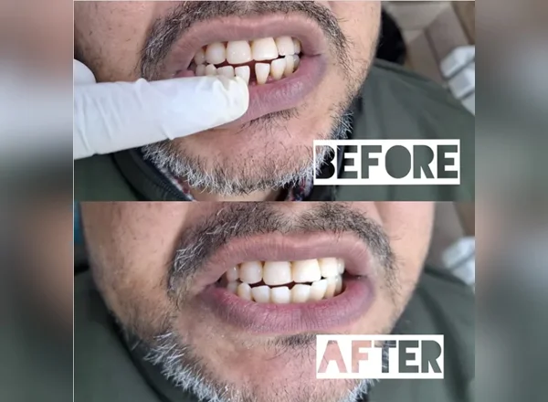 Before and After