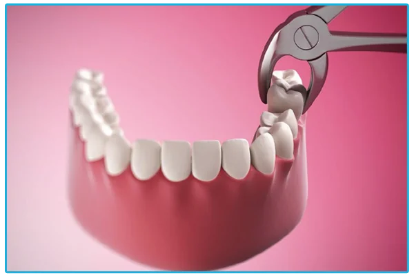 Impaction