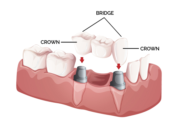 Crown and Bridge