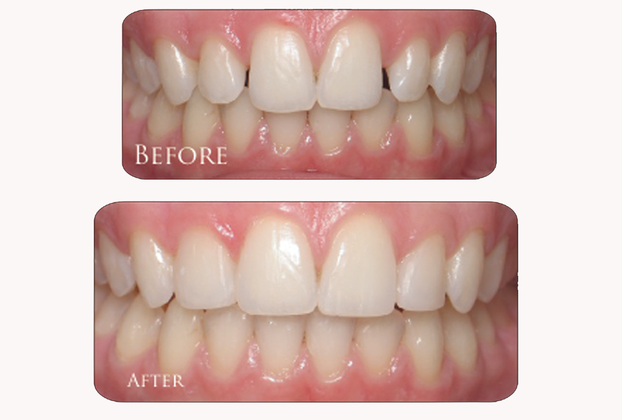 Cosmetic Fillings