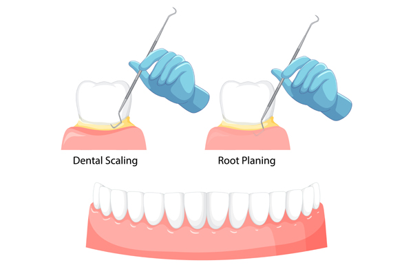 Root Planing & Curettage